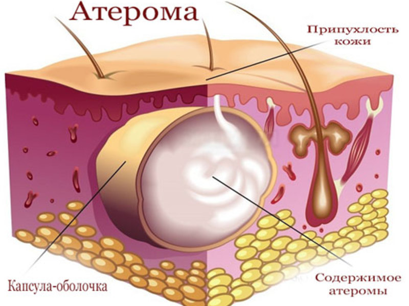 атерома