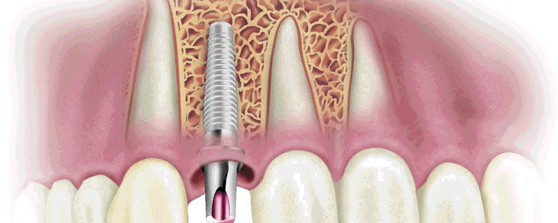 Имплант зуба