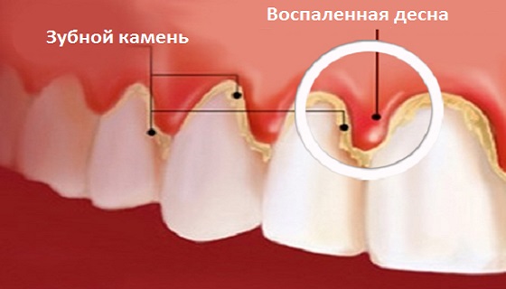 лечение гингивита в Иркутске