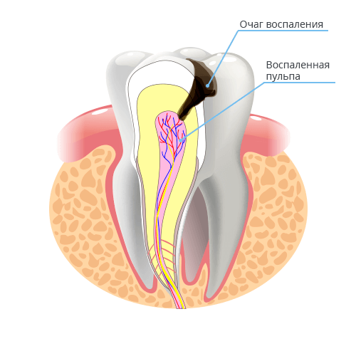 лечение острого пульпита зуба
