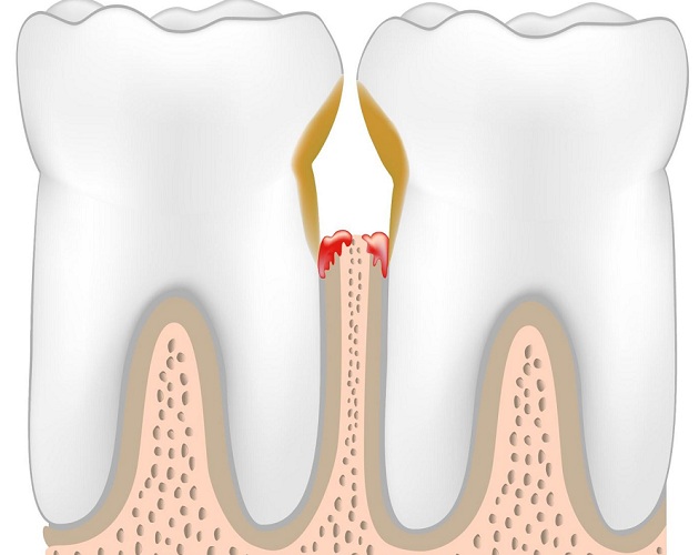 лечение пародонтоза