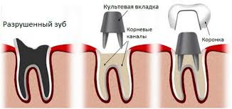 лечение зуба под коронкой