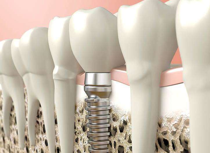 установка зубных имплантов