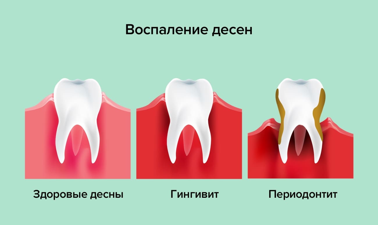 виды воспаления десен