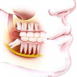 удаление зуба мудрости,последствия